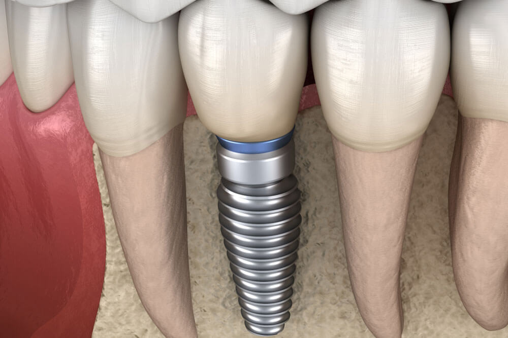 Premolar tooth recovery with implant